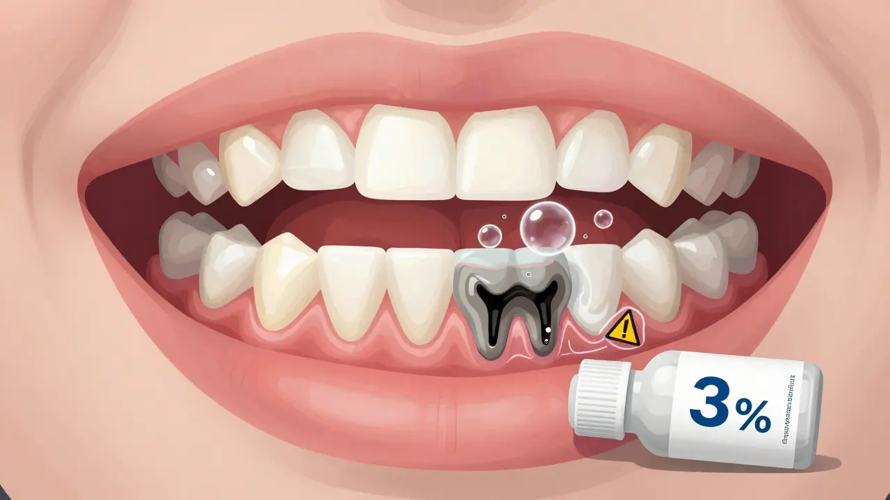 Zubní tkáň poškozená peroxidem vodíku, s viditelným ničením skloviny a dásní.